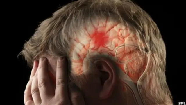 SOS en tu cerebro: Señales de alerta de una apoplejía o derrame cerebral