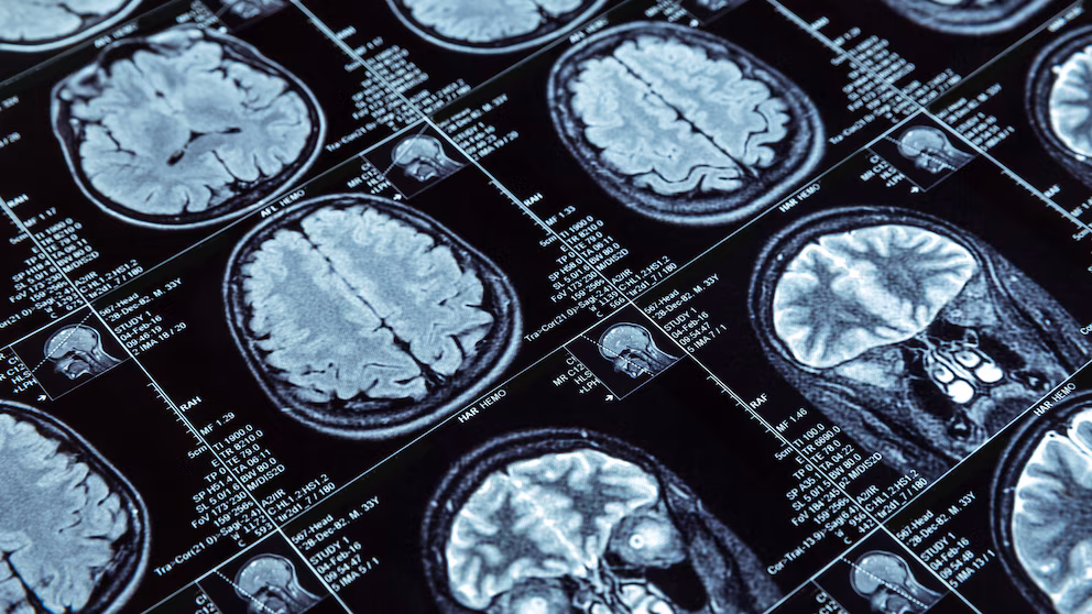 Un estudio de Harvard revela que la deficiencia de litio es una de las causas del Alzheimer
